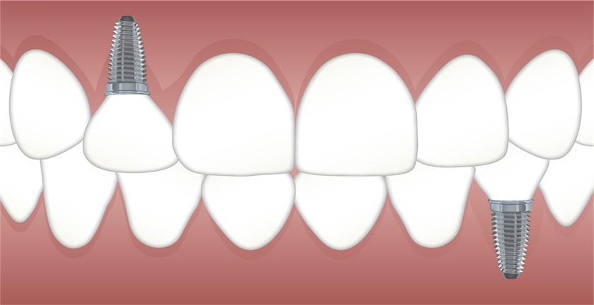 Pros and Cons of Dental Implants
