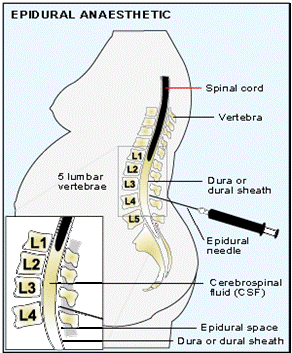 Pros and Cons of Epidural