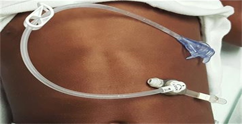 Pros and Cons of J Tube