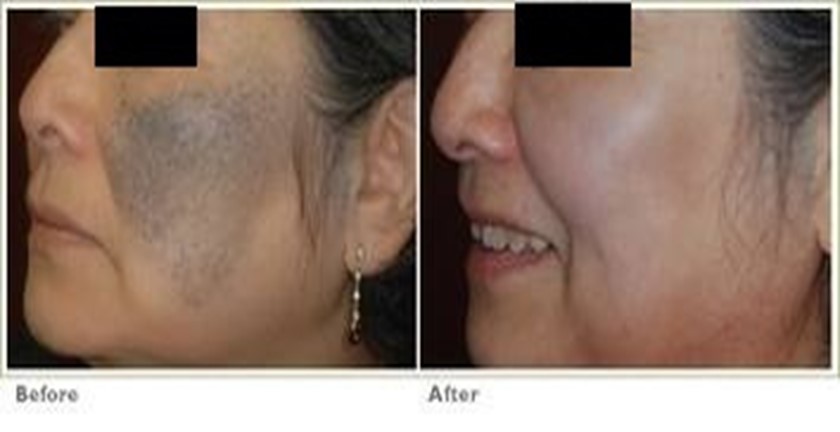 Pros and Cons of Q-Switch Laser