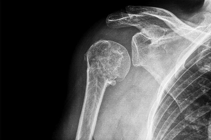 Pros And Cons Of Reverse Shoulder Replacement