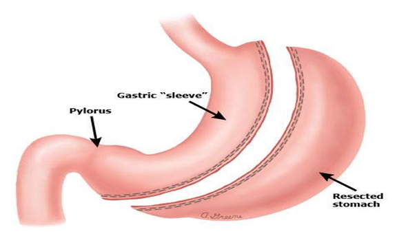 Pros and cons of gastric sleeve